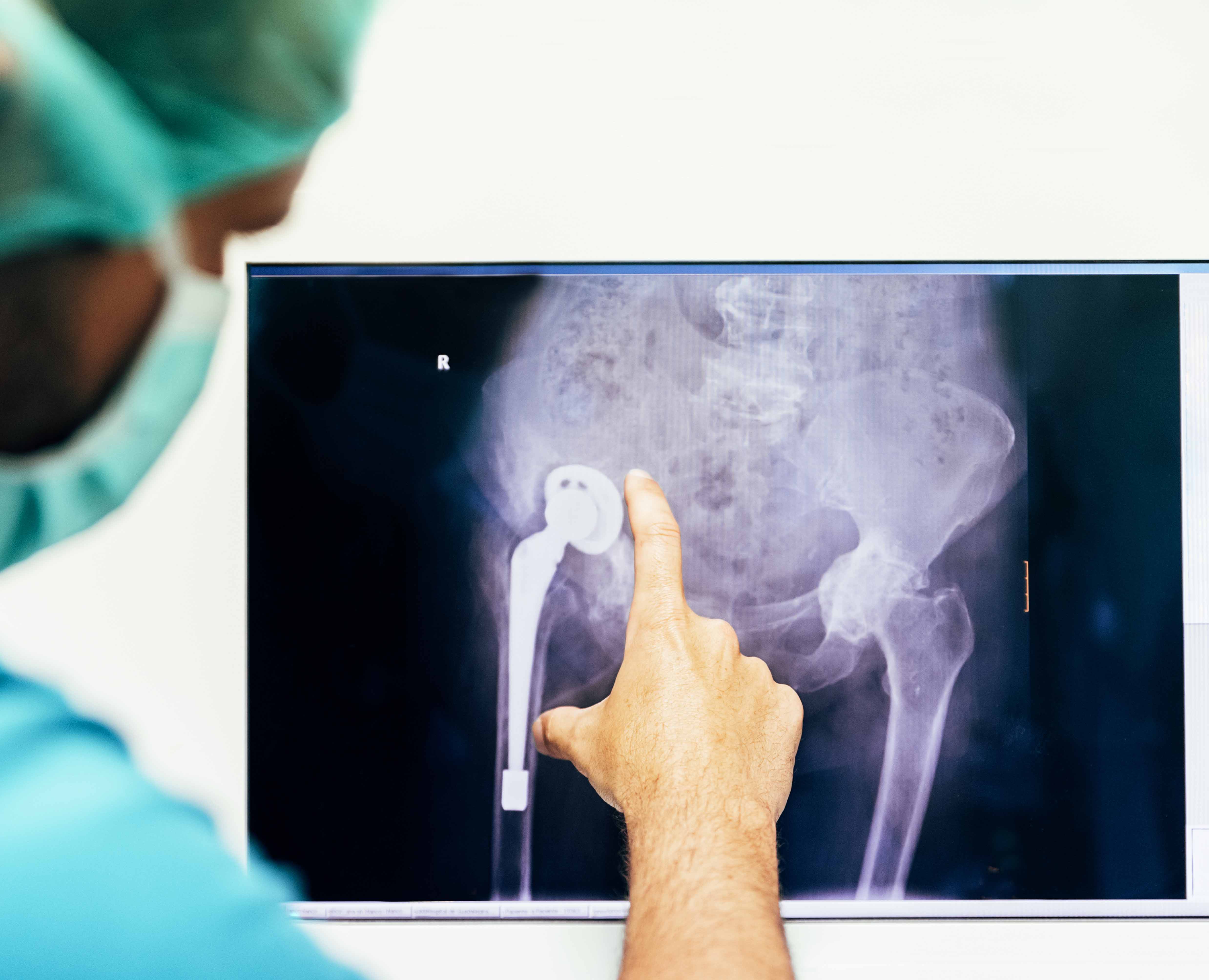 Hip Replacement